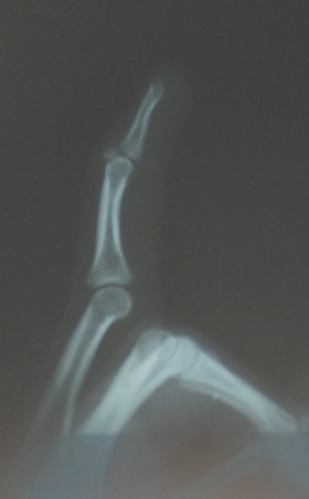 My Left Middle Finger